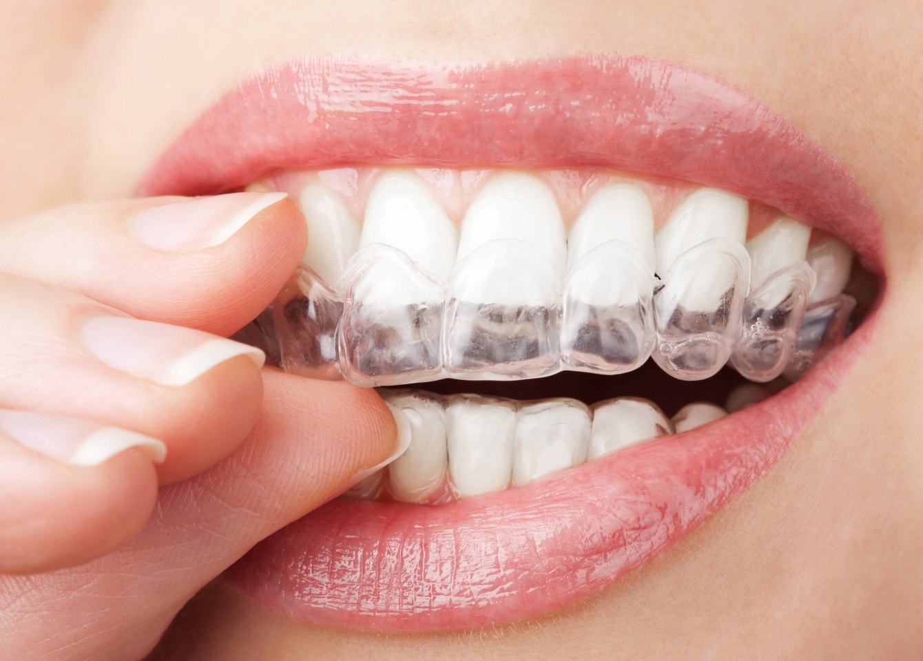 Invisalign